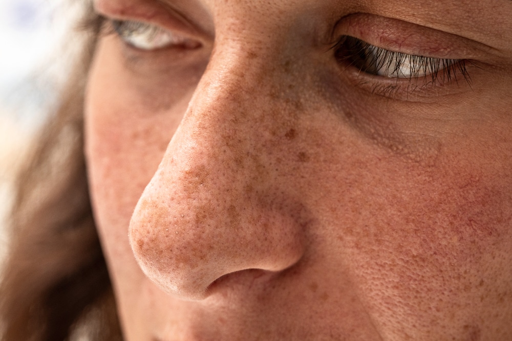 Close-up portrait of young woman with freckles and sun spots on nose and cheeks, showing skin damage from harmful UV rays.